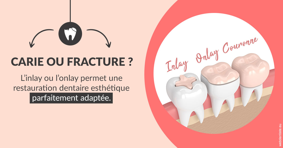 https://dr-henry-jeanluc.chirurgiens-dentistes.fr/T2 2023 - Carie ou fracture 2