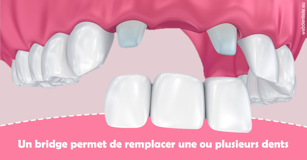 https://dr-henry-jeanluc.chirurgiens-dentistes.fr/Bridge remplacer dents 2
