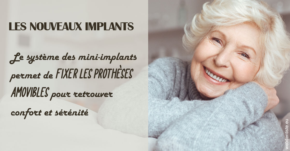 https://dr-henry-jeanluc.chirurgiens-dentistes.fr/Les nouveaux implants 1