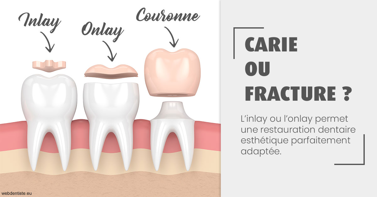 https://dr-henry-jeanluc.chirurgiens-dentistes.fr/T2 2023 - Carie ou fracture 1