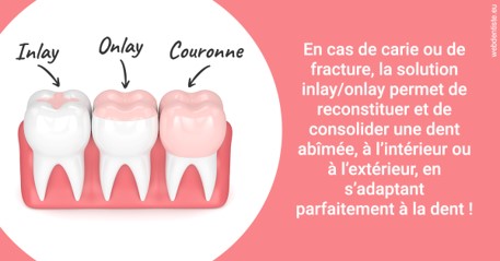 https://dr-henry-jeanluc.chirurgiens-dentistes.fr/L'INLAY ou l'ONLAY 2