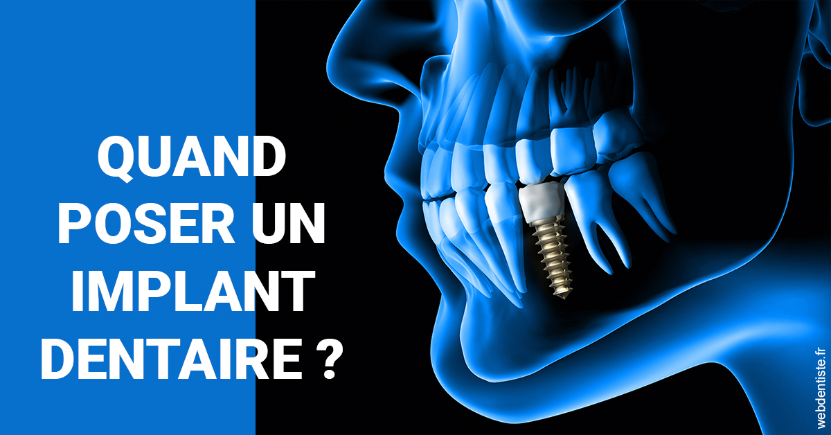 https://dr-henry-jeanluc.chirurgiens-dentistes.fr/Les implants 1
