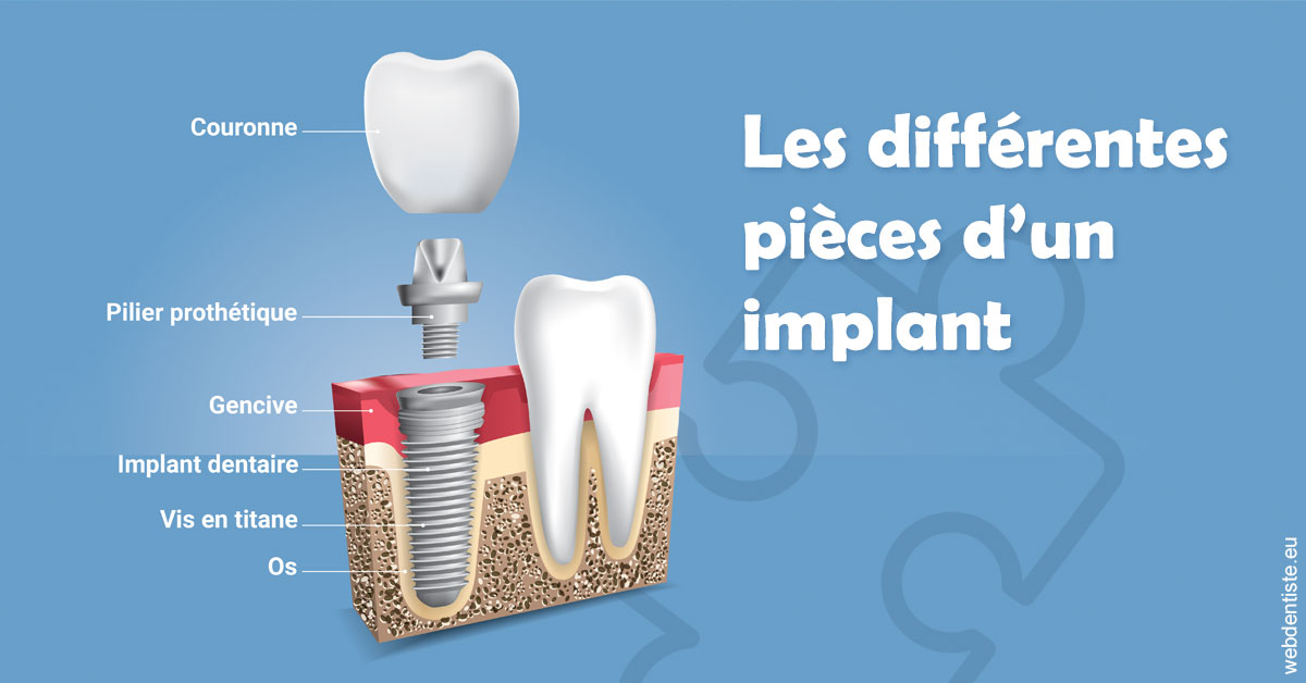 https://dr-henry-jeanluc.chirurgiens-dentistes.fr/Les différentes pièces d’un implant 1